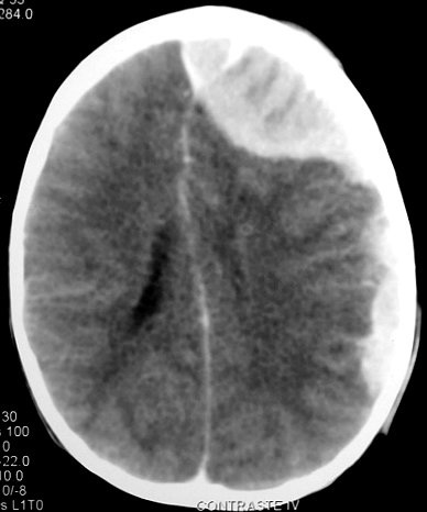 Adrenal_Neuroblastoma11_UNICAMP_resized.jpg