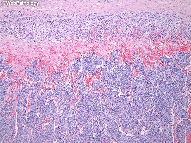 Adrenal_Neuroblastoma11_Undiff.jpg