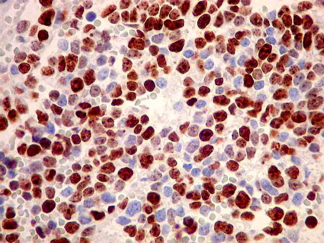 Adrenal_Neuroblastoma12_UNICAMP_Ki67_resized.jpg