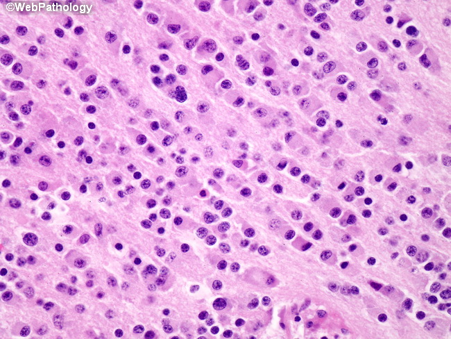 Adrenal_Neuroblastoma26_Diff.jpg