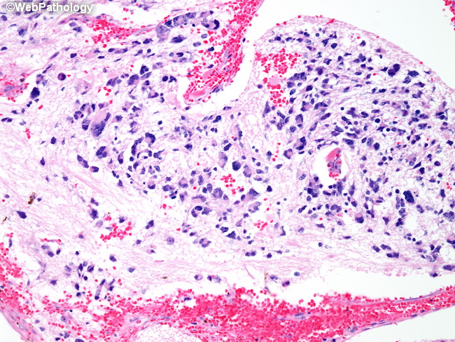 Adrenal_Neuroblastoma34.jpg