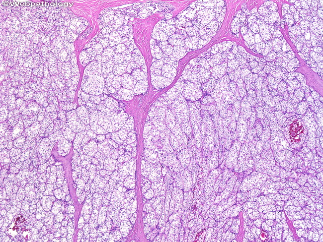 AlveolarSoftPartSarcoma1.jpg