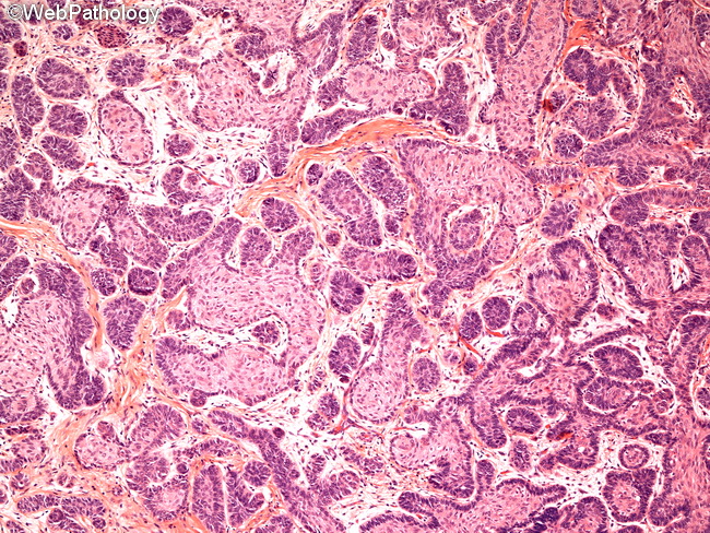 Ameloblastoma10A.jpg