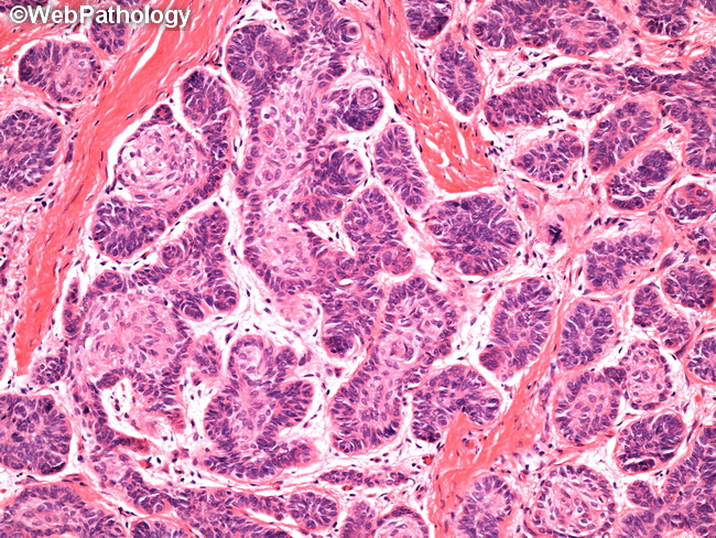 Ameloblastoma13A.jpg