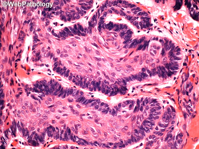 Ameloblastoma14A.jpg