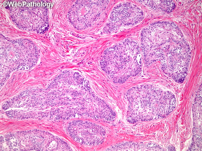 Ameloblastoma15A.jpg
