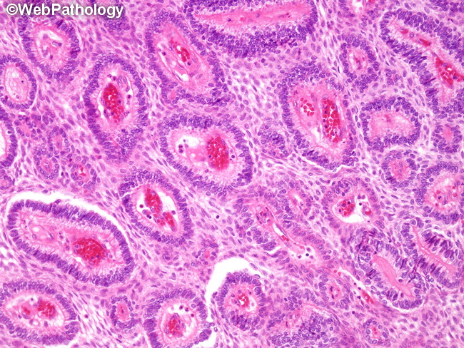 Ameloblastoma21A.jpg