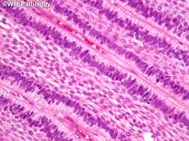 Ameloblastoma24A.jpg