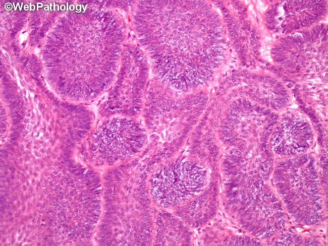 Ameloblastoma27A_Basaloid.jpg