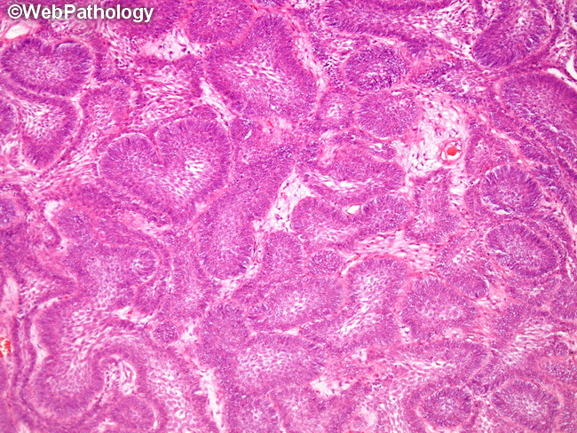 Ameloblastoma28A_Basaloid.jpg