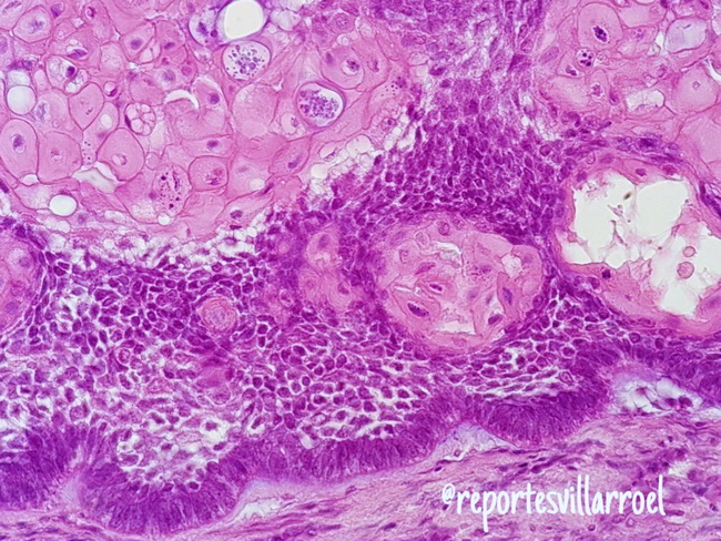 Ameloblastoma35_Acanthomatous.jpg