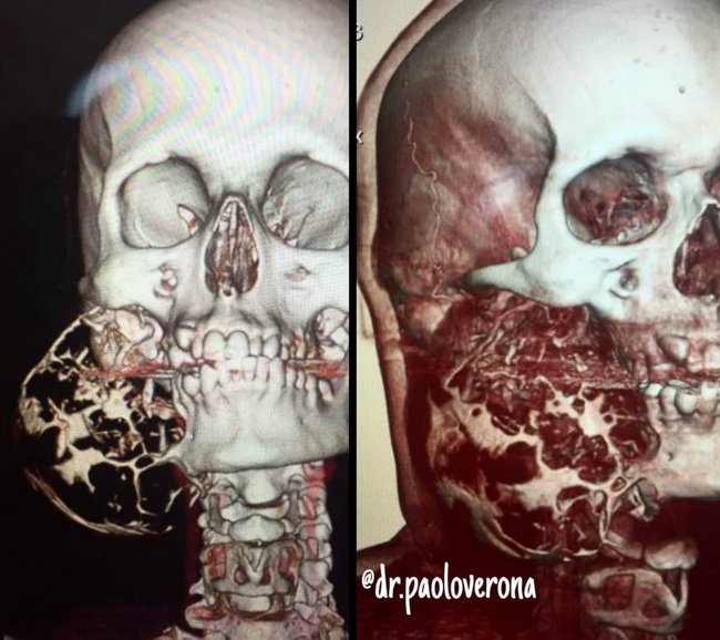 Ameloblastoma37_resized.jpg