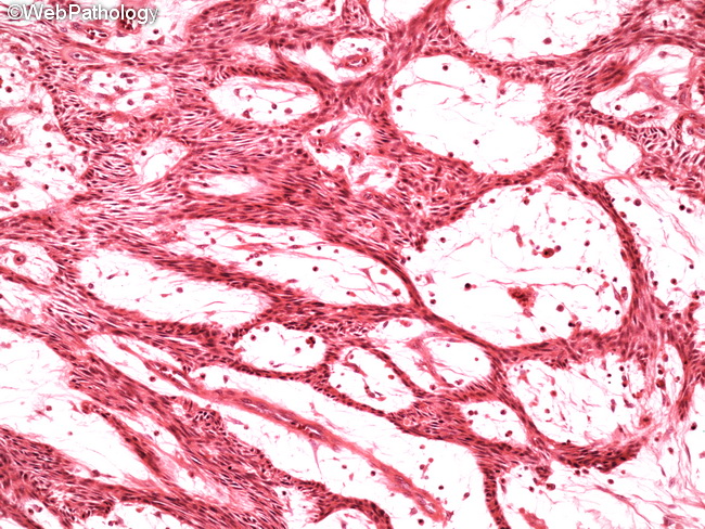 Ameloblastoma3_Plexiform.jpg
