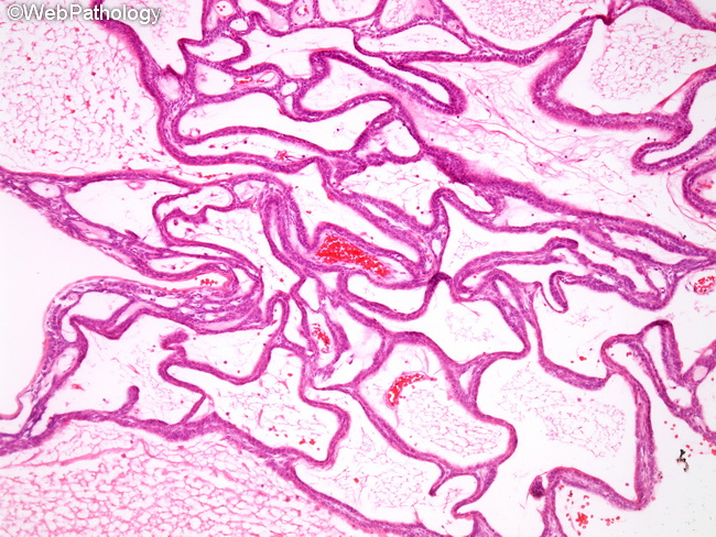 Ameloblastoma4_Plexiform.jpg