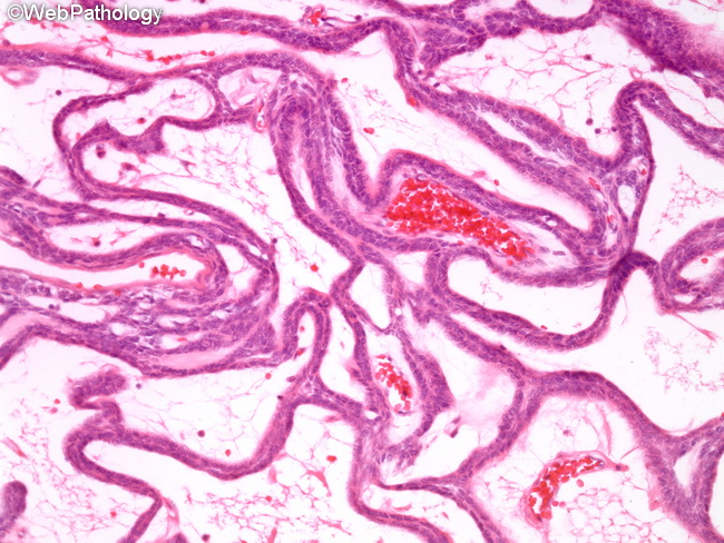 Ameloblastoma5_Plexiform.jpg