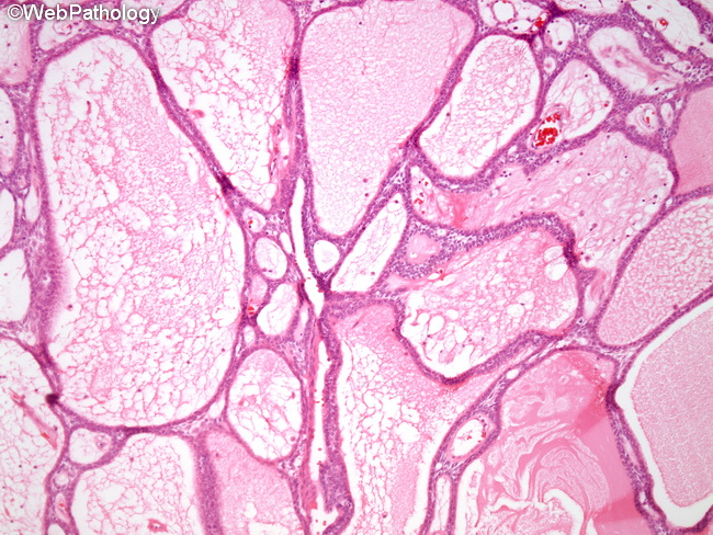 Ameloblastoma7_Plexiform.jpg