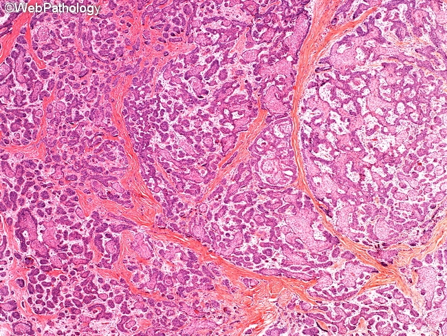 Ameloblastoma8A.jpg