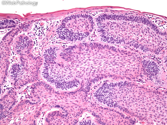 Ameloblastoma_Extraosseous5_OralCavity.jpg