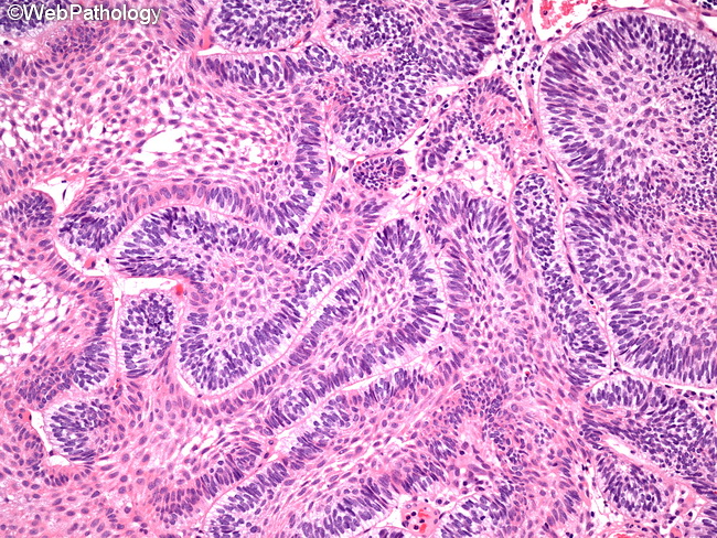 Peripheral Ameloblastoma Histology