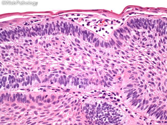 Ameloblastoma_Extraosseous8_OralCavity.jpg
