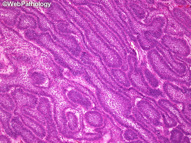 Ameloblastoma_Maxilla2.jpg