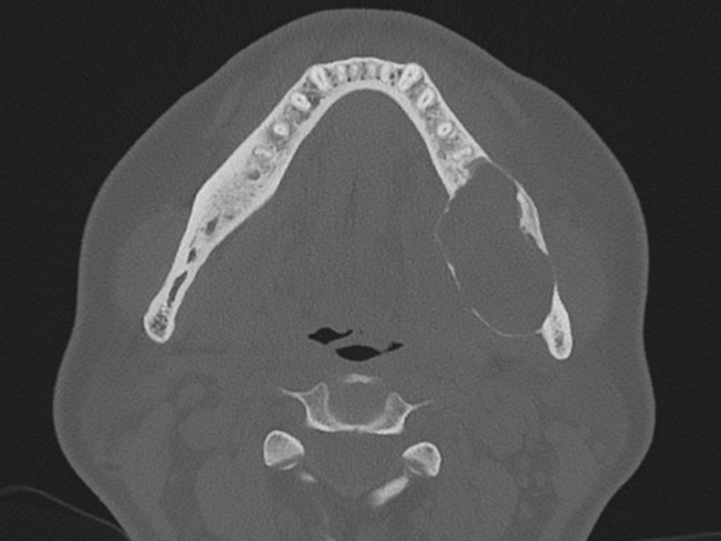 Ameloblastoma_Radiology1_cropped.jpg