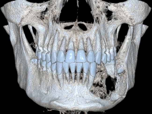 Ameloblastoma_Radiology2B_cropped.jpg