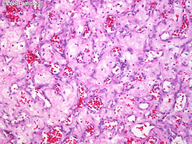 Angiosarcoma2_lowgrade_breast.jpg