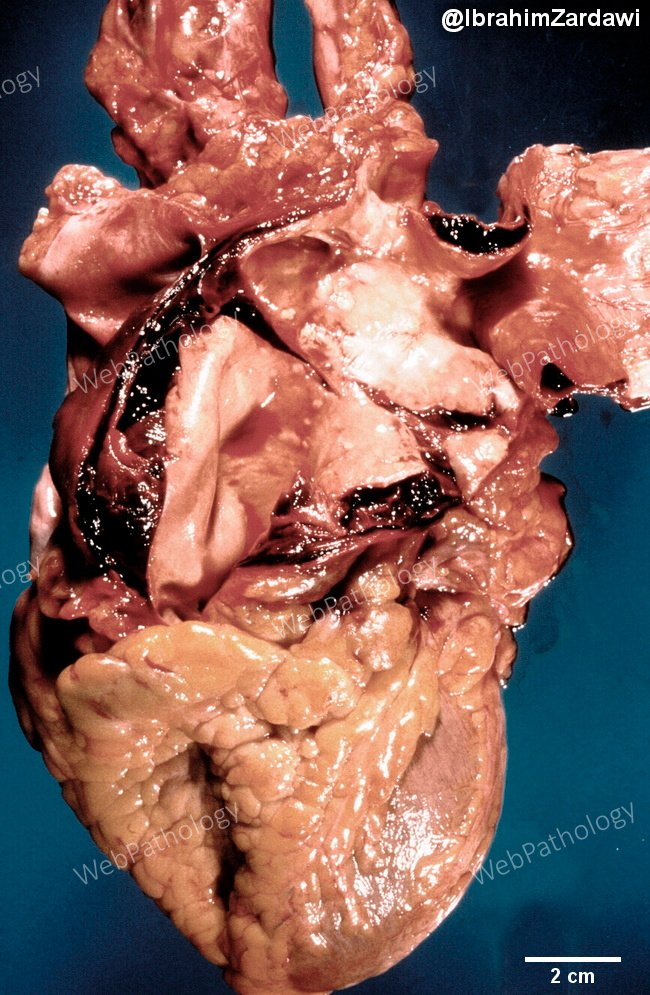 Aorta_aneurysm23_dissecting_resized_IZ.jpg