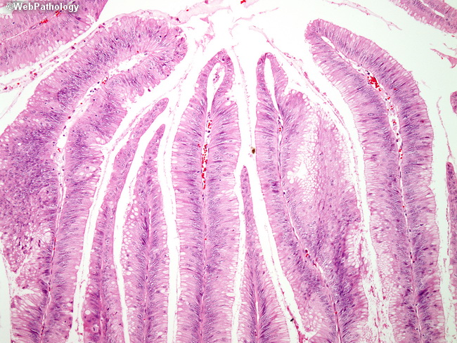 Appendix_MucinousCystadenoma3.jpg