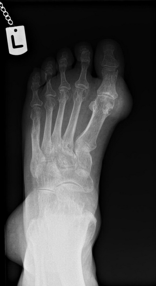 Bone_Gout_Radiology6_resized.jpg