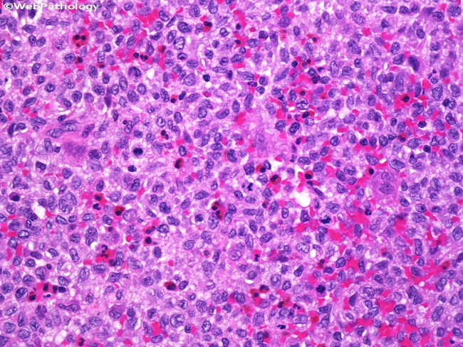 Bone_LangerhansCellHistiocytosis3.jpg