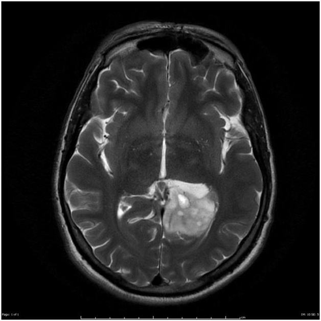 Brain_Astrocytoma_Anaplastic_Radiology(1).jpg