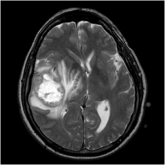 Brain_Astrocytoma_GBM_Radiology1(1).jpg