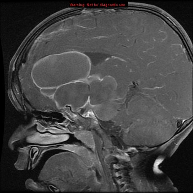 Brain_Craniopharyngioma_Ad_Radiology2.jpg