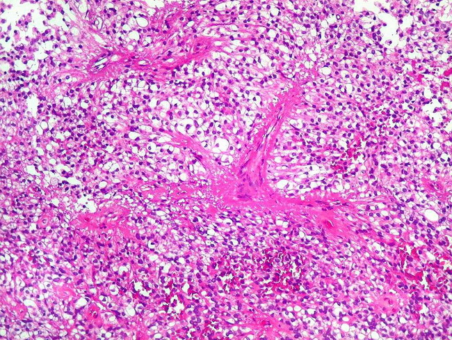Brain_Ependymoma22_ClearCell_Unicamp.jpg