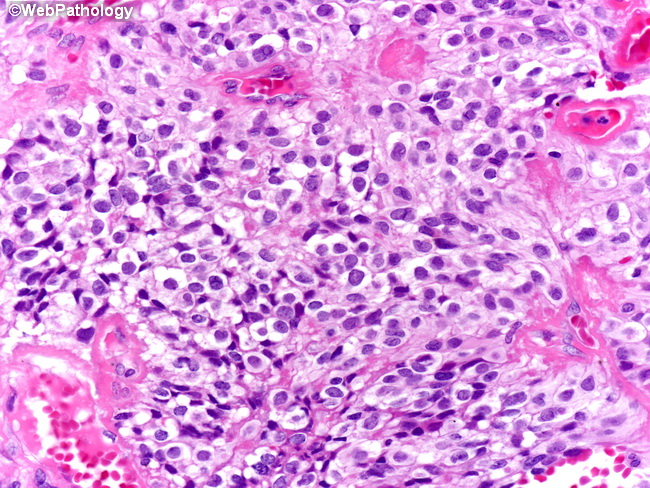 Brain_Ependymoma_ClearCell1.jpg