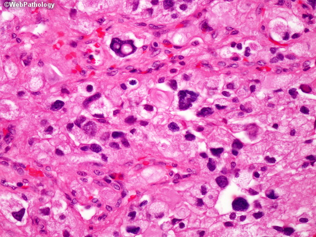 Brain_Hemangioblastoma25.jpg