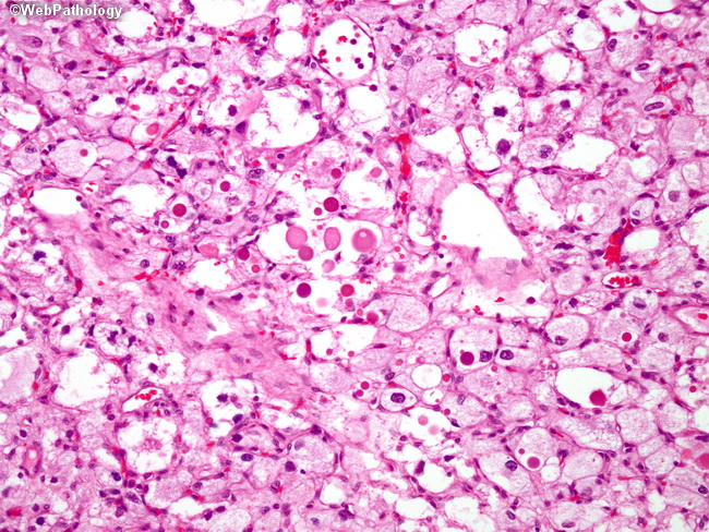 Brain_Hemangioblastoma26.jpg