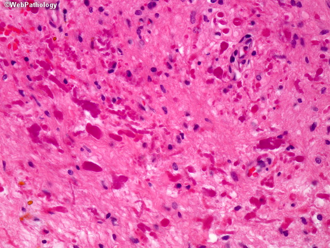 Brain_Hemangioblastoma27.jpg