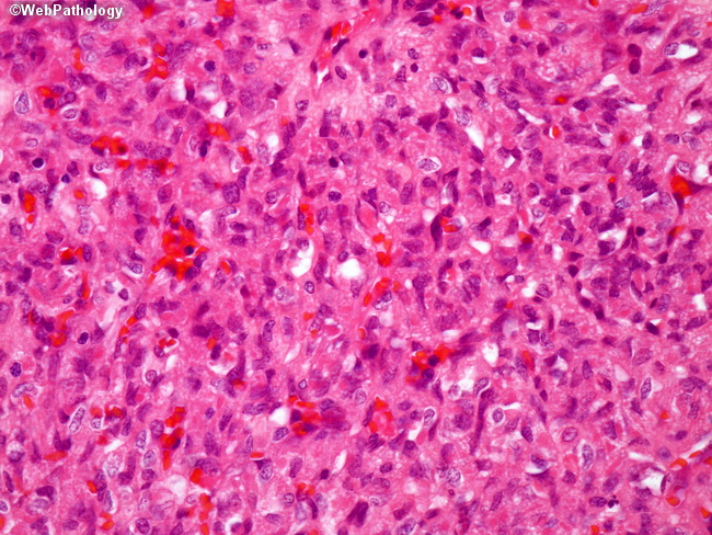 Brain_Hemangioblastoma29.jpg