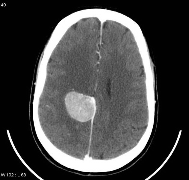 Brain_Meningioma_Radiology1_CT.jpg