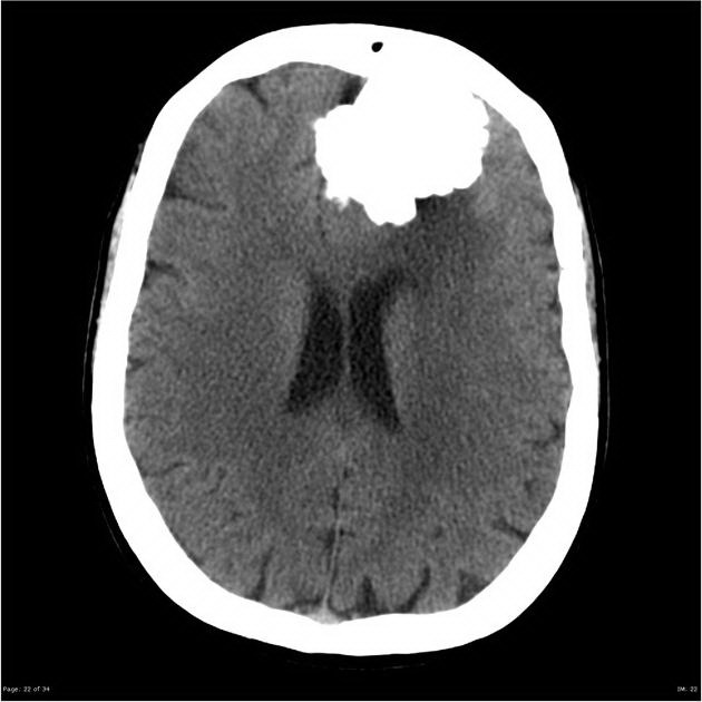 Brain_Meningioma_Radiology2_CT.jpg