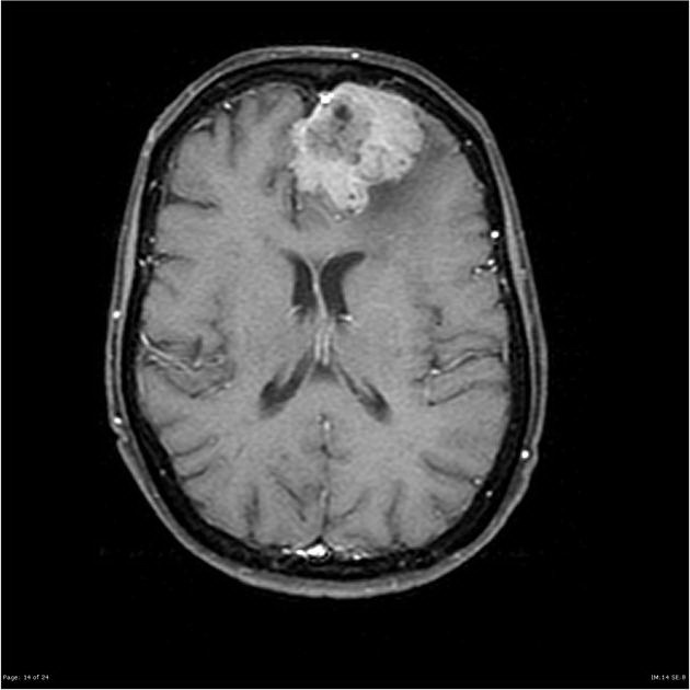 Brain_Meningioma_Radiology3.jpg