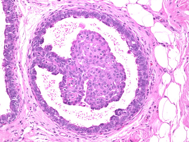 Papillomatosis Seen In Histopathology Breast Intraductal Papilloma My