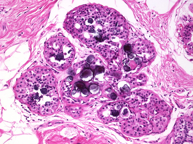 Breast_Benign_Microcalcifications.jpg