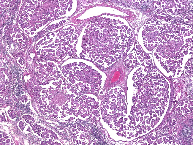 Breast_Carcinoma_Micropapillary1.jpg