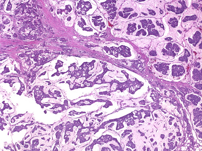 Breast_ColloidCarcinoma1.jpg