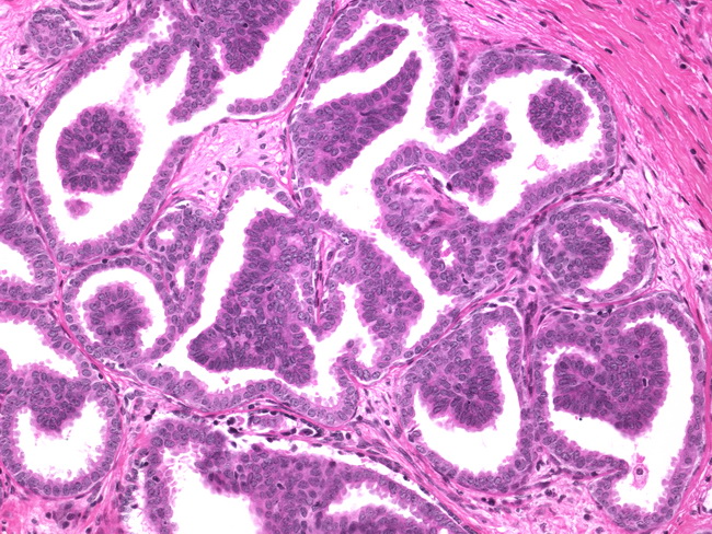 Ductal epithelial hyperplasia breast