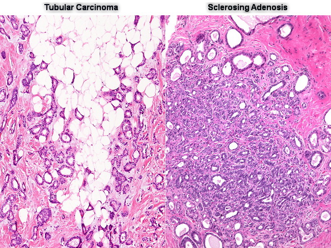 Breast_TubularCA_VS_SclAdenosis.jpg